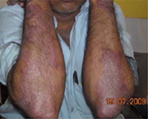 Psoriasis before treatment picture