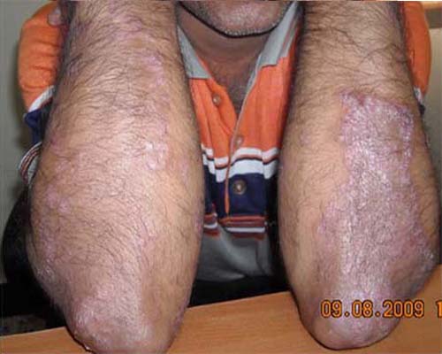 Psoriasis during treatment picture