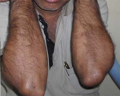 Psoriasis after treatment picture